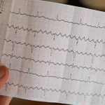 Afib vs. Vfib similarities, differences & treatment post img