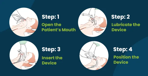 How to use supraglottic airway devices post img