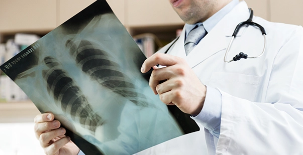 Img 1 A Complete Guide to Cracked Ribs Diagnosis and Treatment