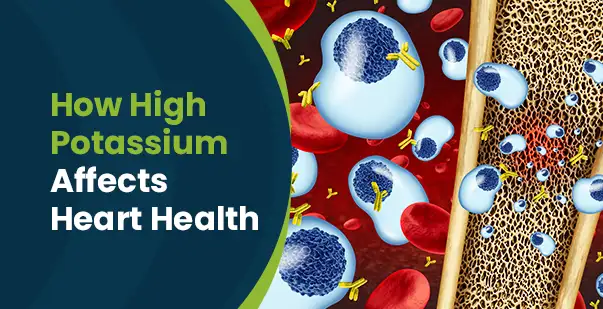 Illustration for What is Hyperkalemia: Effects of High Potassium on the Heart