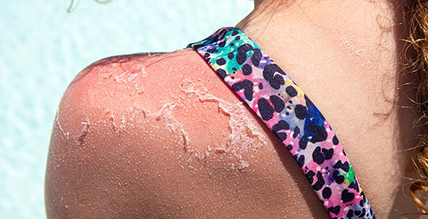 Sunburn first aid tip how to treat sunburn post img