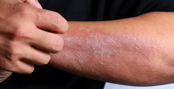 Anaphylaxis causes, symptoms, diagnosis & treatment post img Anaphylaxis causes, symptoms, diagnosis & treatment post img