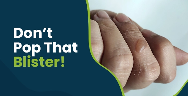 Friction blisters causes, symptoms, and treatment post img