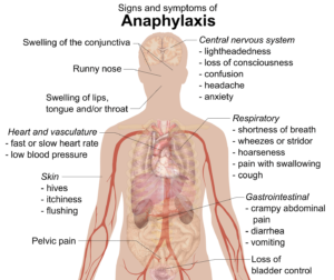 Síntomas de la anafilaxia