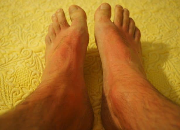 Feet With Red Rash