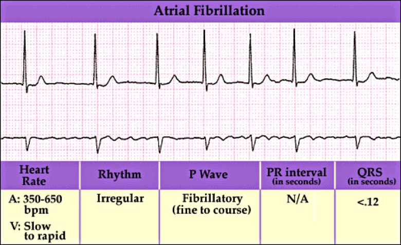 Atrial fibrillation CPR Certification Online