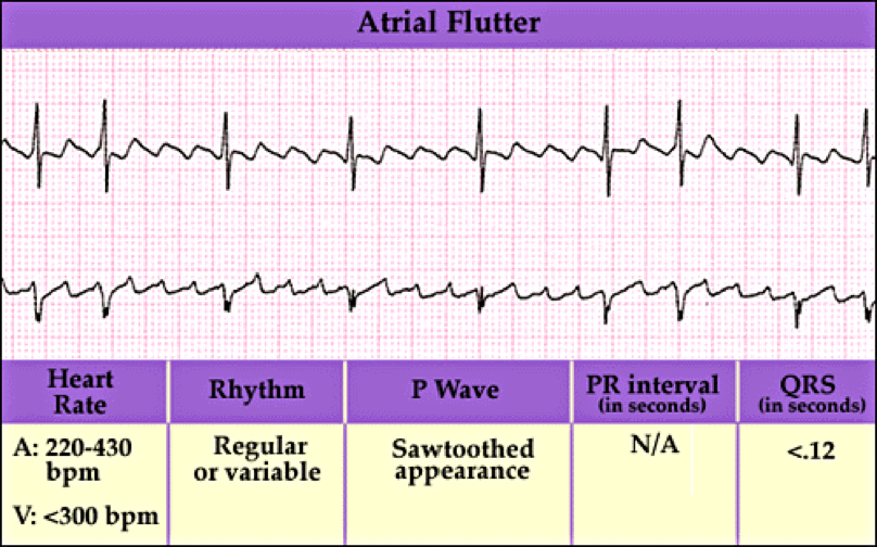 Atrial Flutter CPR Certification Online