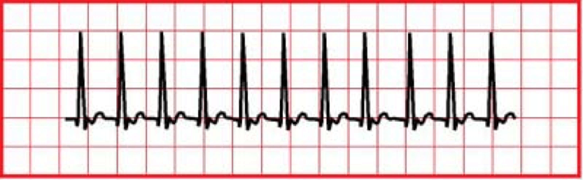 Supraventricular Tachycardia (SVT) CPR Certification Online