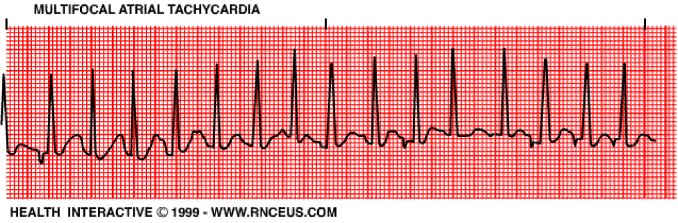 Multifocal Atrial Tachycardia CPR Certification Online