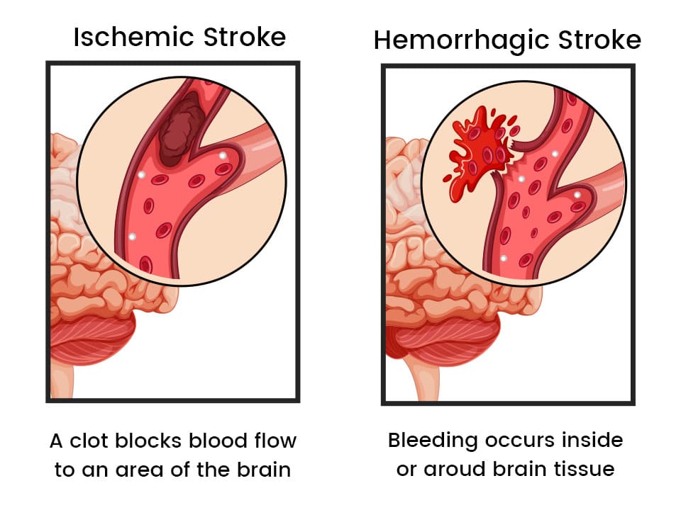 Comparing Ischemic Stroke and Hemorrhagic Stroke visually.
