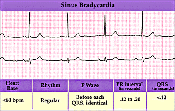 A sinus bradicardia frequency 