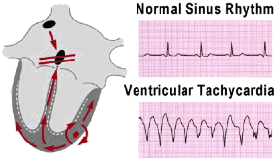Normal Sinus Rhythm from Ventricular Tachycardia.