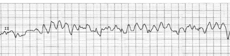 Electrocardiogram frequency photo 