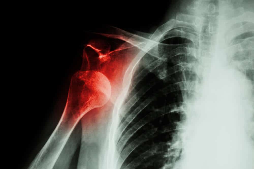 Broken or fractured shoulder bone marked in red