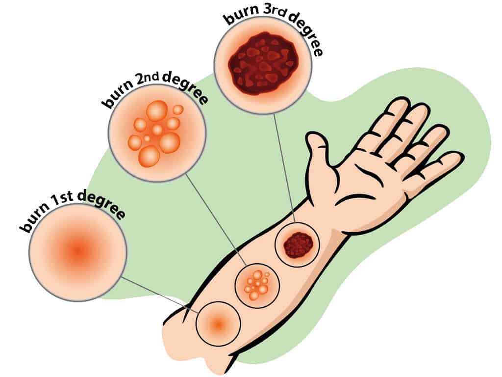 Different types of burns shown in the image