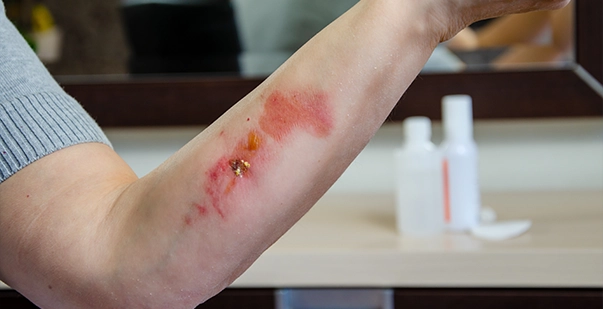 Effective first aid treatment for chemical burns and essential prevention tips post img