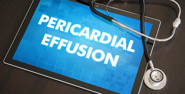 Pericardial Effusion (Fluid Around Heart) Symptoms & Causes