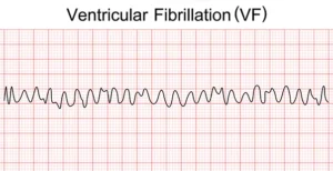 Ventricular Fibrillation (V-Fib) Symptoms, Causes, Treatment