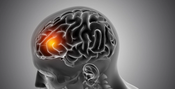 Amyotrophic lateral sclerosis (als) - diagnosis and treatment post img