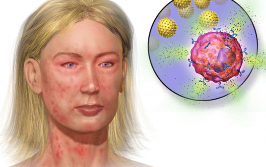 Infection Resulting in Rash