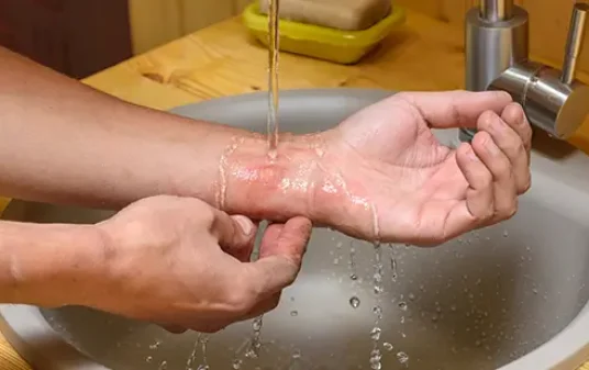 image for first aid for burns