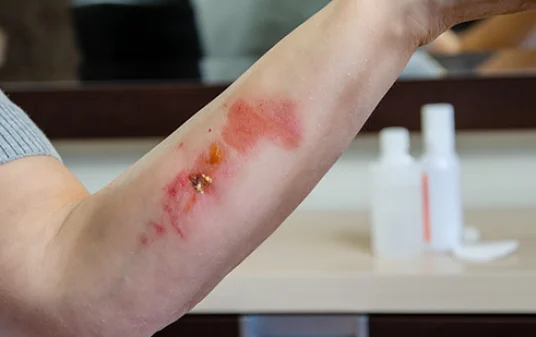 Effective first aid treatment for chemical burns and essential prevention tips post img