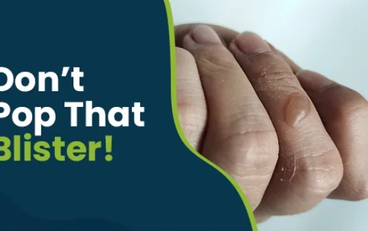 Friction blisters causes, symptoms, and treatment post img