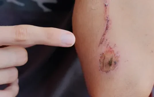 How to attend to a stab wound with first aid post img