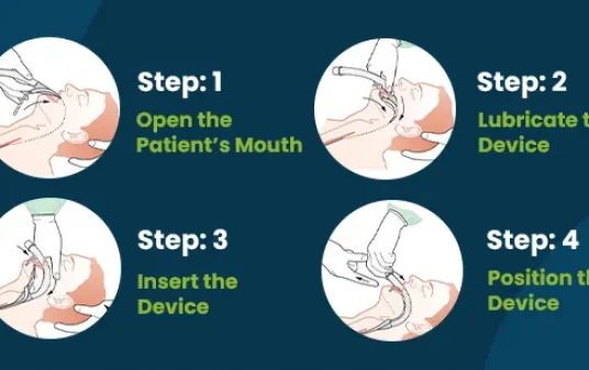 How to use supraglottic airway devices post img