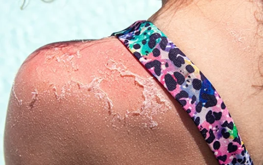 Sunburn first aid tip how to treat sunburn post img